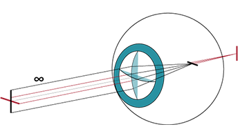 Illustration de l'astigmatisme