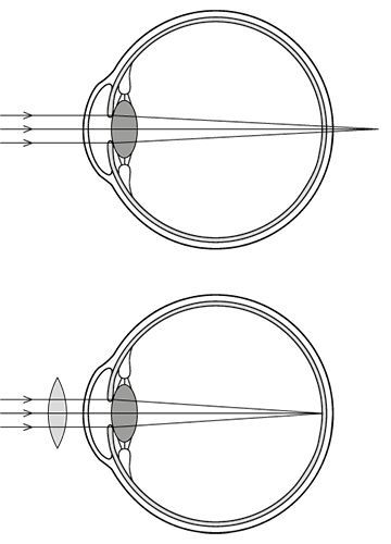 Illustration de l'hypermétropie